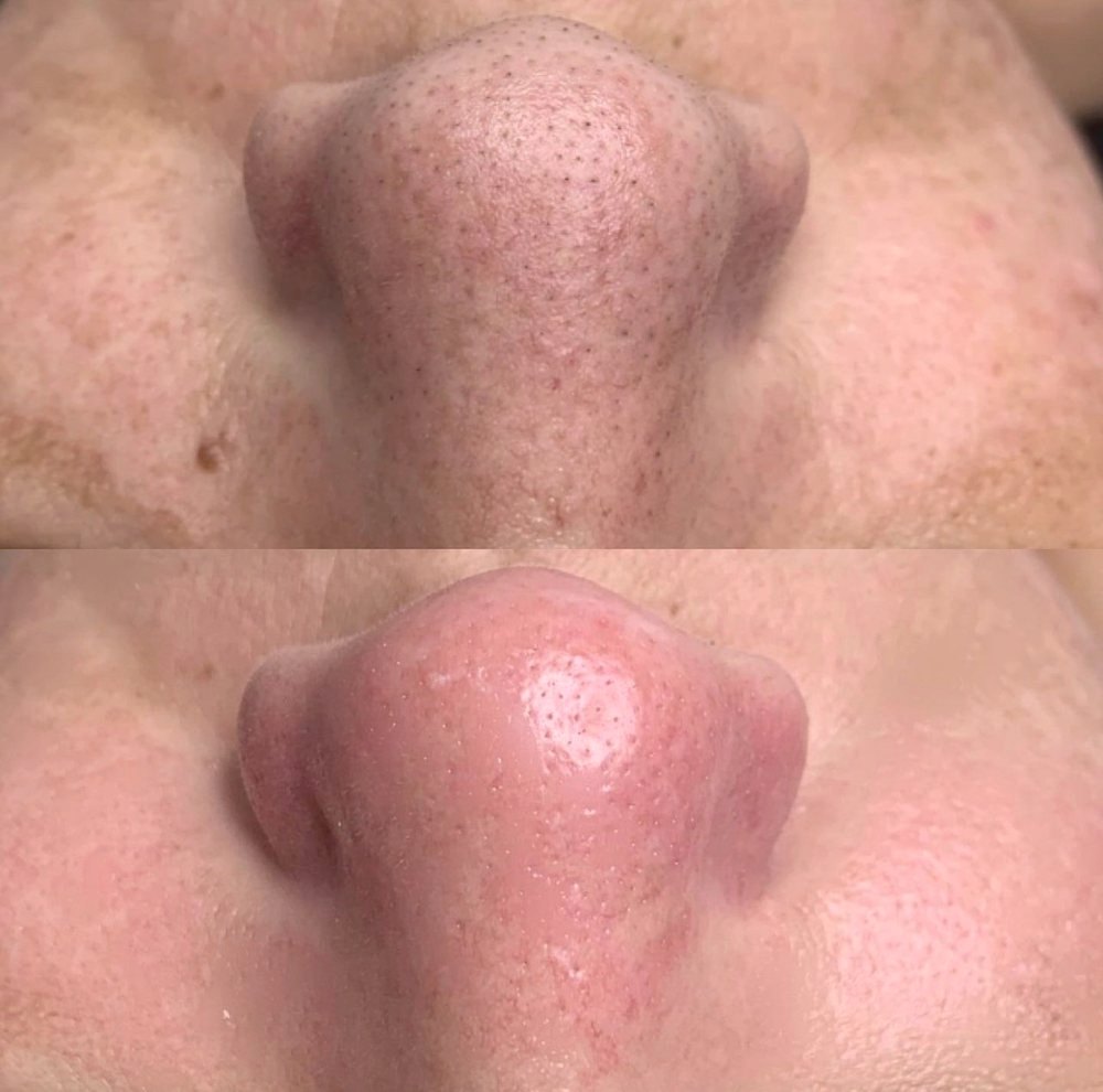 Limpeza de pele, antes em cima e depois embaixo